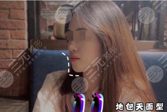 地包天手術(shù)整形費(fèi)用多少錢術(shù)后果