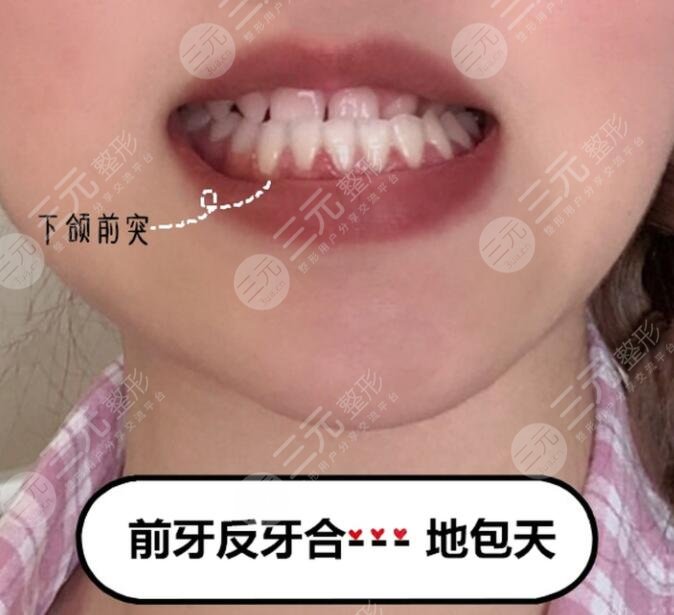 地包天的矯正時(shí)機(jī)