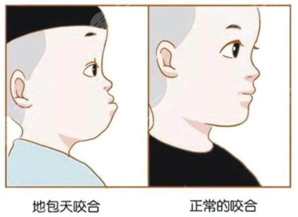 地包天矯正的方法