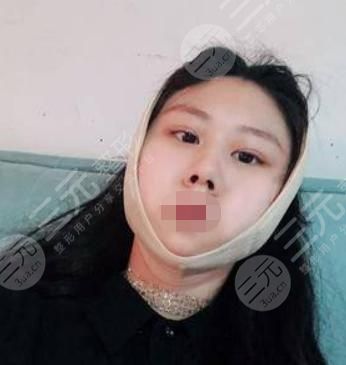 V-LINE瓜子臉手術(shù)術(shù)后4天