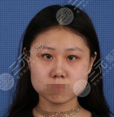 V-LINE瓜子臉手術(shù)術(shù)前