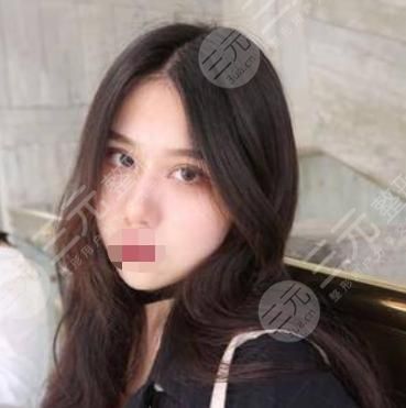 V-LINE瓜子臉手術(shù)術(shù)后33天