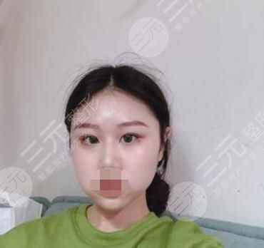 V-LINE瓜子臉手術(shù)術(shù)后14天