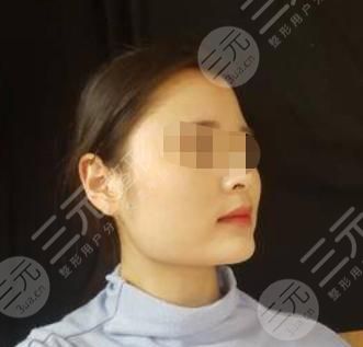 V-LINE瓜子臉手術(shù)術(shù)前