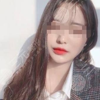 V-LINE瓜子臉手術(shù)術(shù)后34天