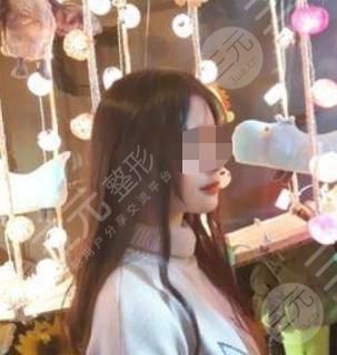 V-LINE瓜子臉手術(shù)術(shù)后16天