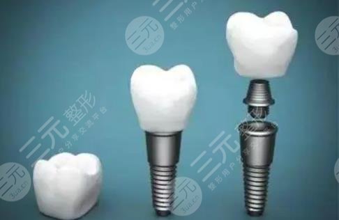 種植牙