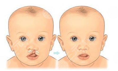 兔唇修復后的疤痕可以去掉嗎