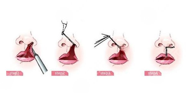 兔唇矯正手術(shù)之后需要怎么去護理