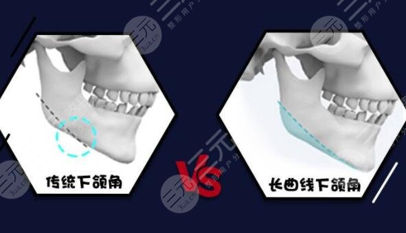 下頜角整形術(shù)有危險(xiǎn)嗎