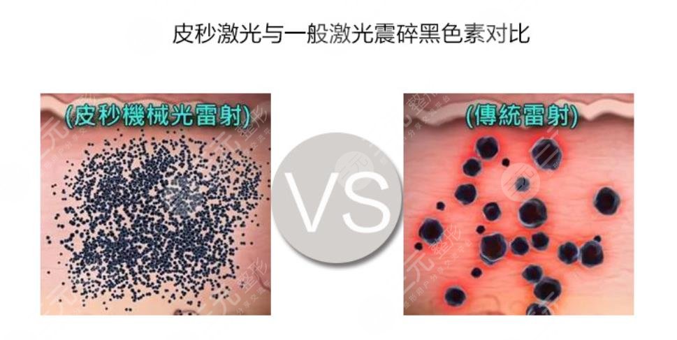 激光pm激光和光子嫩膚的區(qū)別