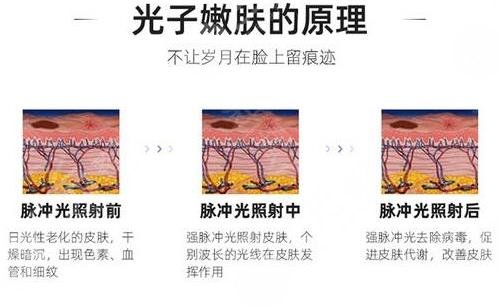 激光pm激光和光子嫩膚的區(qū)別