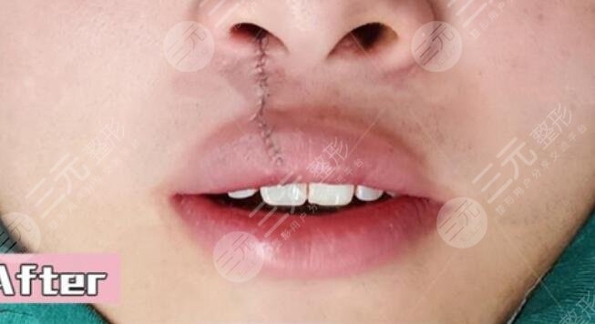 真人兔唇矯正后