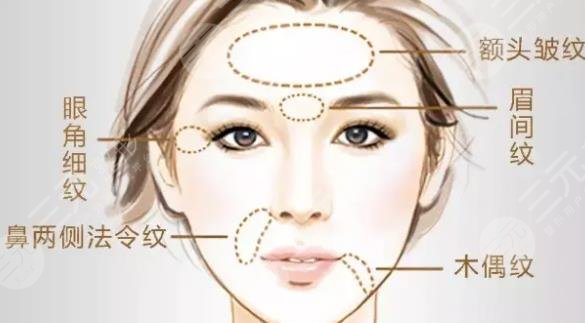 注射除皺能保持多久