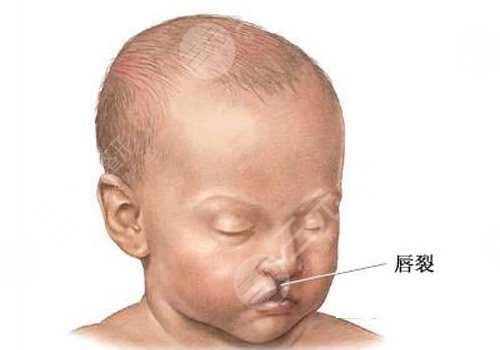 兔唇疤痕修復(fù)的時機(jī)是什么時候