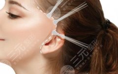 拉皮手術(shù)恢復(fù)期是多長(zhǎng)時(shí)間？拉皮手術(shù)果維持幾年？拉皮手術(shù)案例