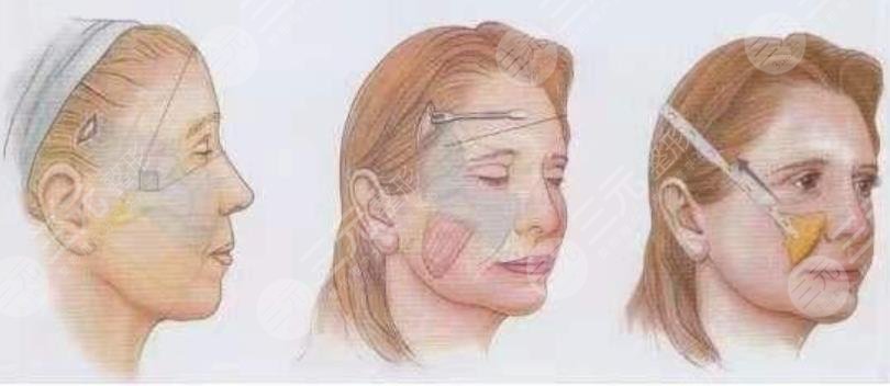 中面部抗衰術(shù)的費(fèi)用怎么樣