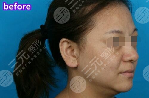 玻尿酸除皺前側(cè)面