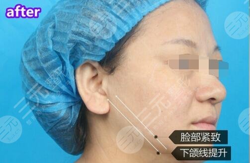 玻尿酸除皺后果