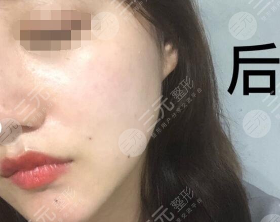 真人體驗激光除皺后 果