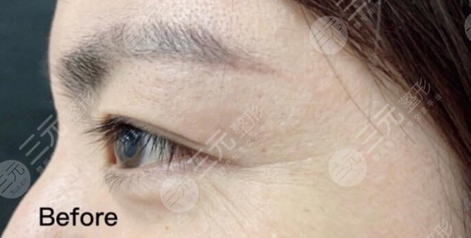 注射除皺可以打眼睛下面的細(xì)紋嗎