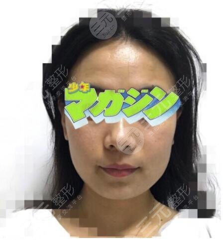 真人展示注射除皺前