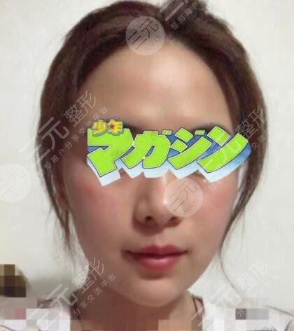 真人展示注射除皺后一個月