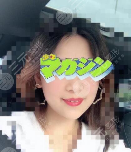 真人展示注射除皺后果