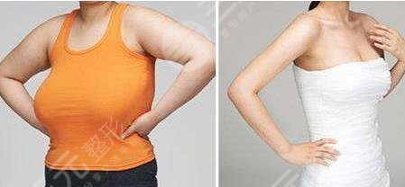 棒棒糖縮胸手術都有什么優(yōu)點