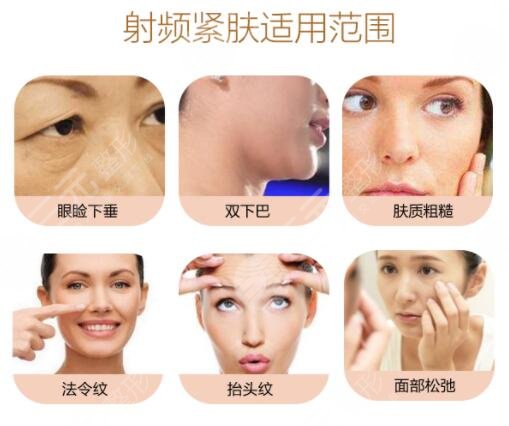 做射頻緊膚的注意事項