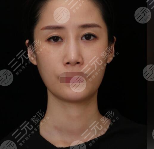 射頻緊膚真人案例術前