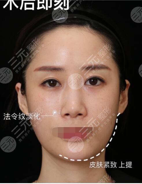 射頻緊膚真人案例術后