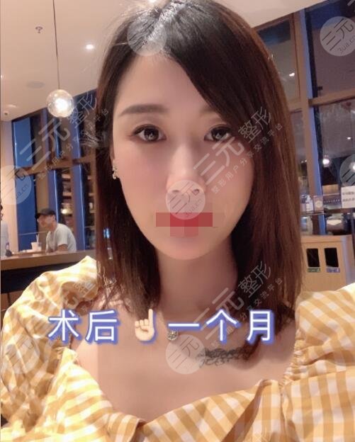 射頻除皺手術后一個月