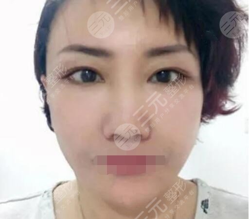 真人中面部抗衰術(shù)后一周