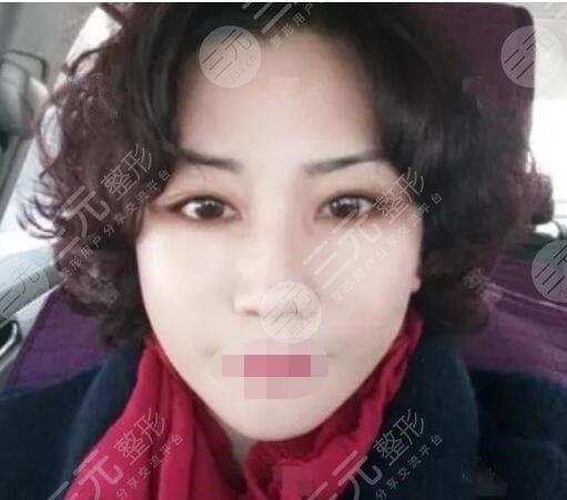 真人中面部抗衰術(shù)后5周