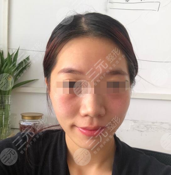 除皺案例后一周