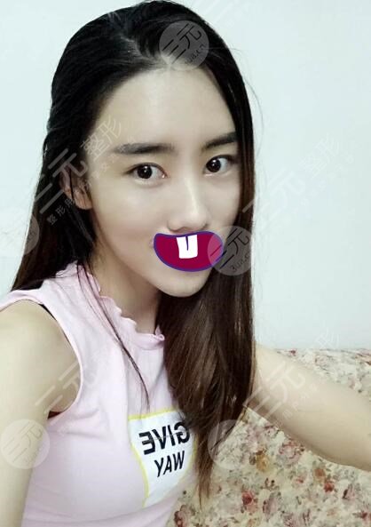 生物注射除皺網(wǎng)友體驗(yàn)果術(shù)后一個月