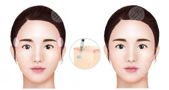 太陽凹陷怎樣變飽滿