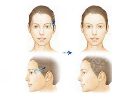 太陽凹陷怎樣變飽滿