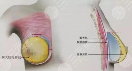 做硅膠隆胸的術(shù)后護(hù)理