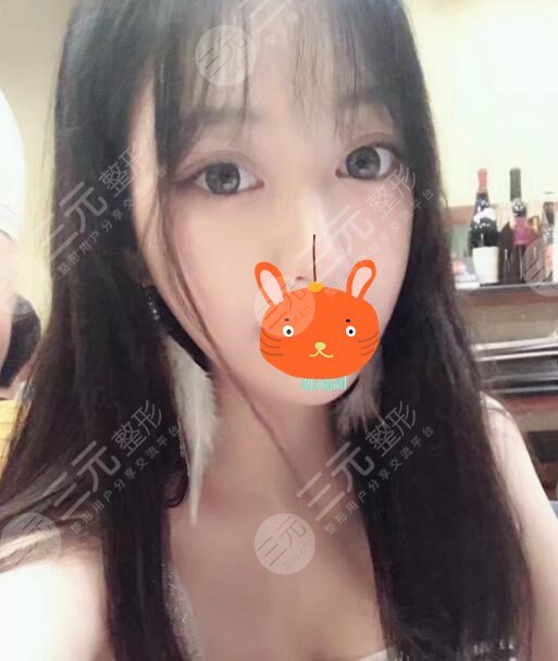 激光除皺后一個月