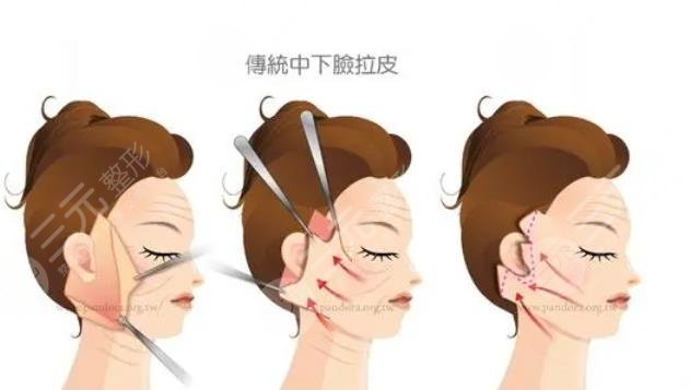 小拉皮手術(shù)優(yōu)勢與缺點(diǎn)中立分析