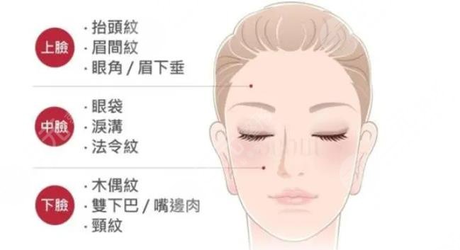 小拉皮手術(shù)可以去淚溝和法令紋嗎