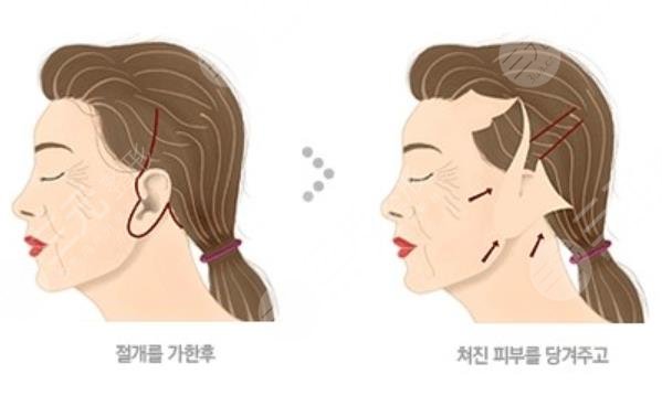 面部拉皮手術(shù)的風(fēng)險副作用