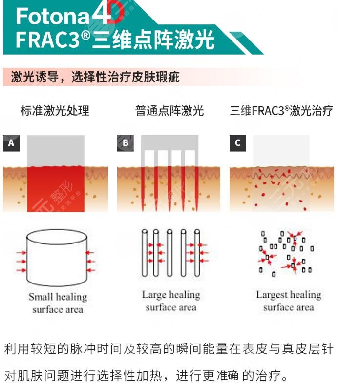 歐洲之星點(diǎn)陣激光降低風(fēng)險(xiǎn)嗎