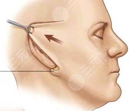 小拉皮手術(shù)