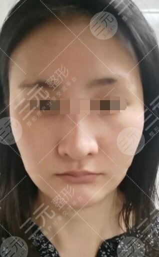 小拉皮手術(shù)前