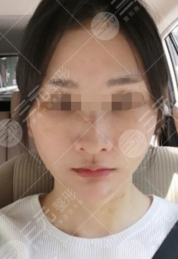 小拉皮手術(shù)后