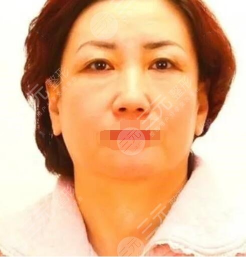 小拉皮手術(shù)案例前