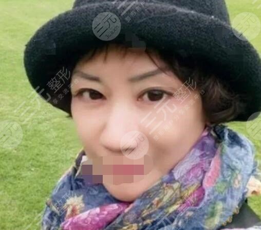 小拉皮手術(shù)案例后2周